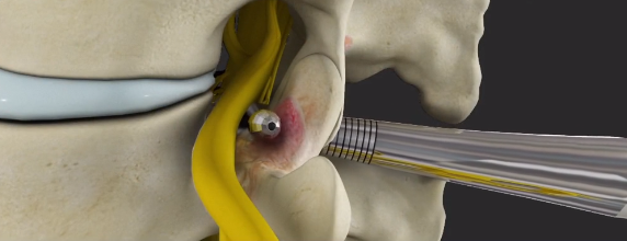 Spinal Stenosis Surgical - The Gerling Institute